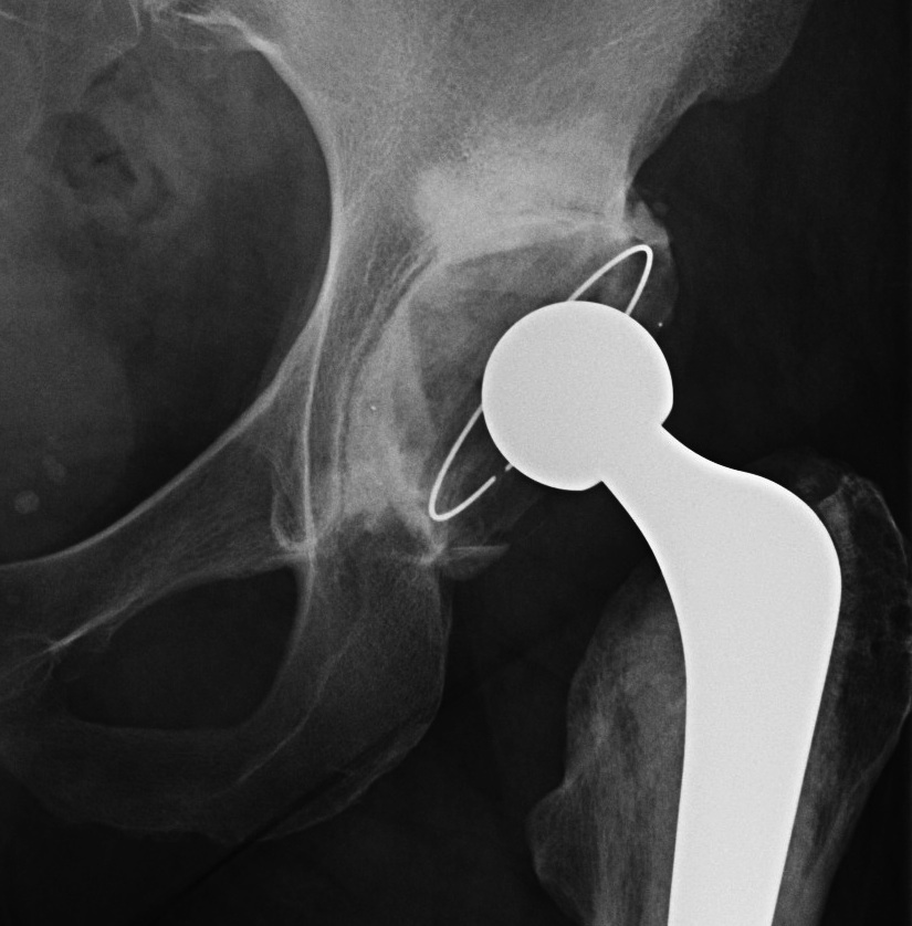 Cemented Cup 3 Zone Lysis